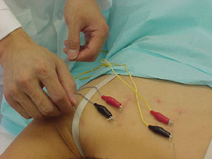 Electric Acupuncture